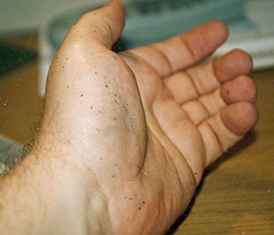 Beruf: Silbernitrat hinterlässt kleine schwarze Punkte in der Haut, die man nicht abwaschen kann Beruf: Silbernitrat hinterlässt kleine schwarze Punkte in der Haut, die man nicht abwaschen kann