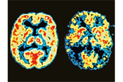 Alzheimer-Früherkennung: Demenz: Sollte man sich testen lassen?