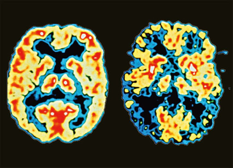 Alzheimer-Früherkennung: Mit Tomographen lassen sich Gehirne schichtweise nach auffälligen Strukturen untersuchen