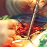 Frei tropfende Methode