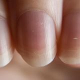 Fingernägel, Flecken