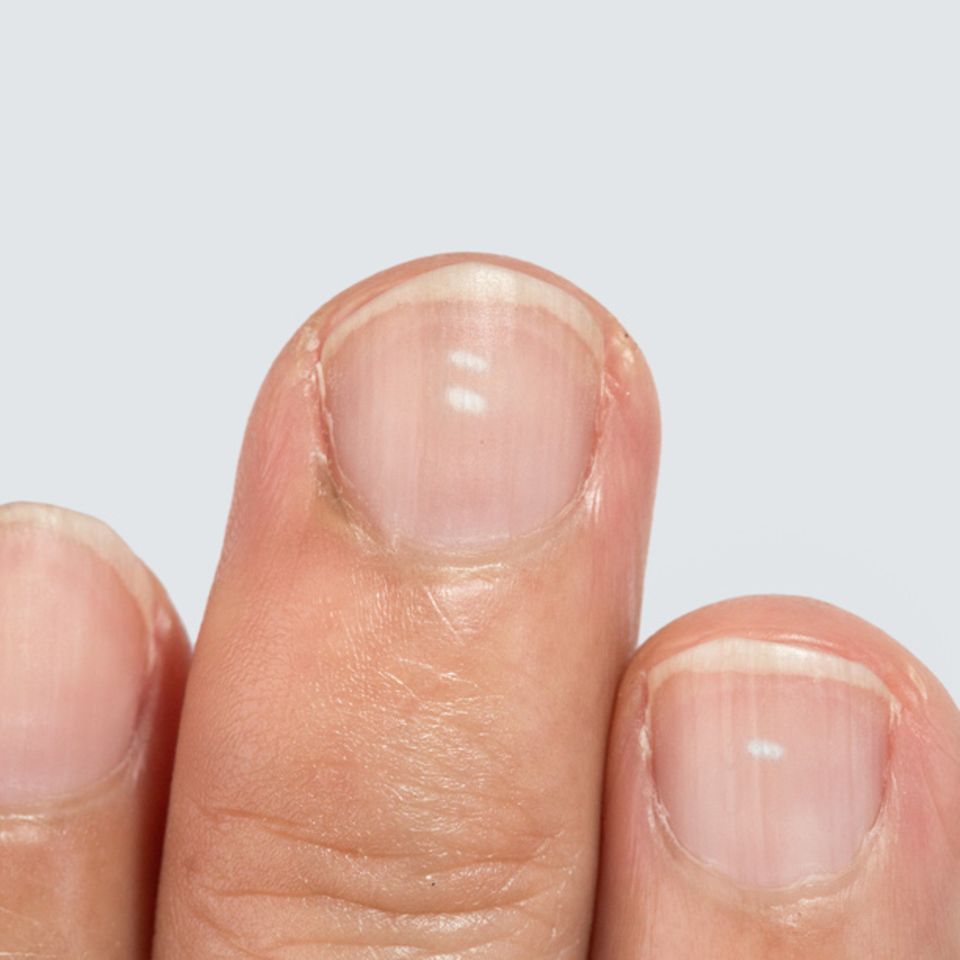 Endlich verstehen: Auch auf den gepflegtesten Fingernägeln können von Zeit zu Zeit die unliebsamen, weißen Flecken auftauchen. Woher kommen sie?