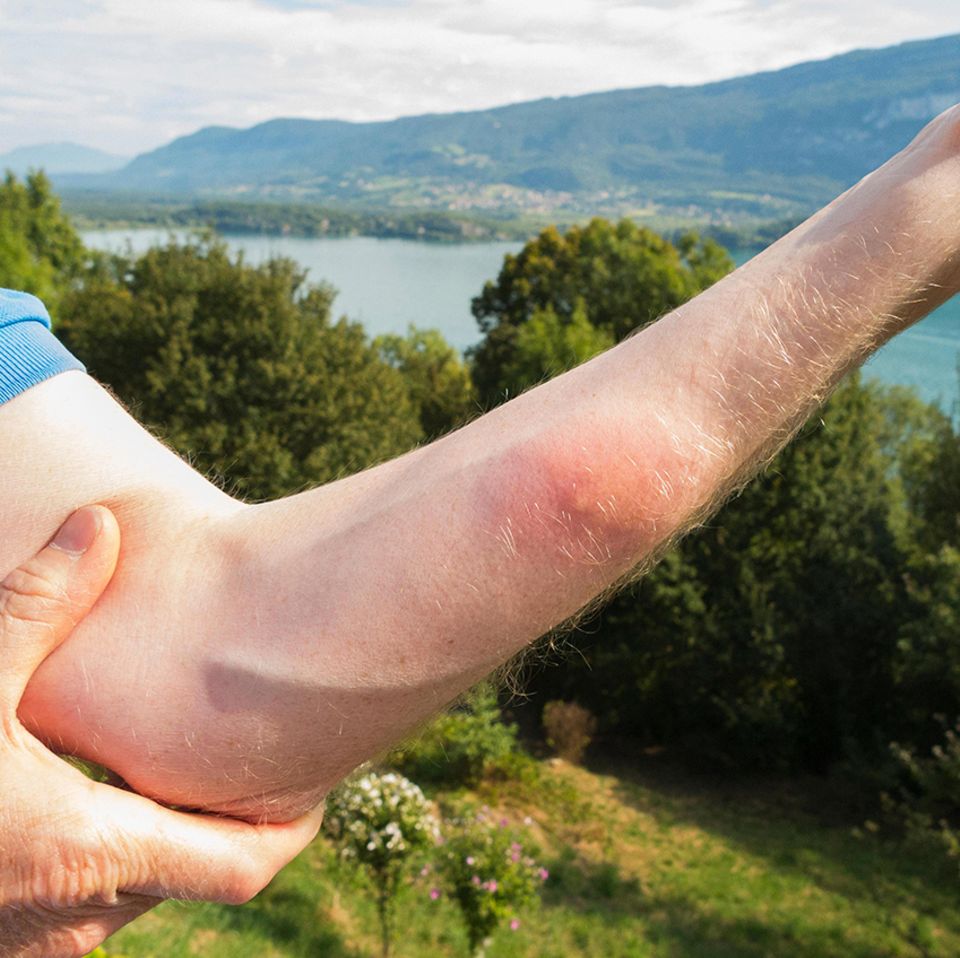 Vorsicht in Badegewässern: Die sogenannte Badedermatitis wird hervorgerufen durch Larven von Saugwürmern, die versehentlich in menschliche Haut eindringen - und absterben