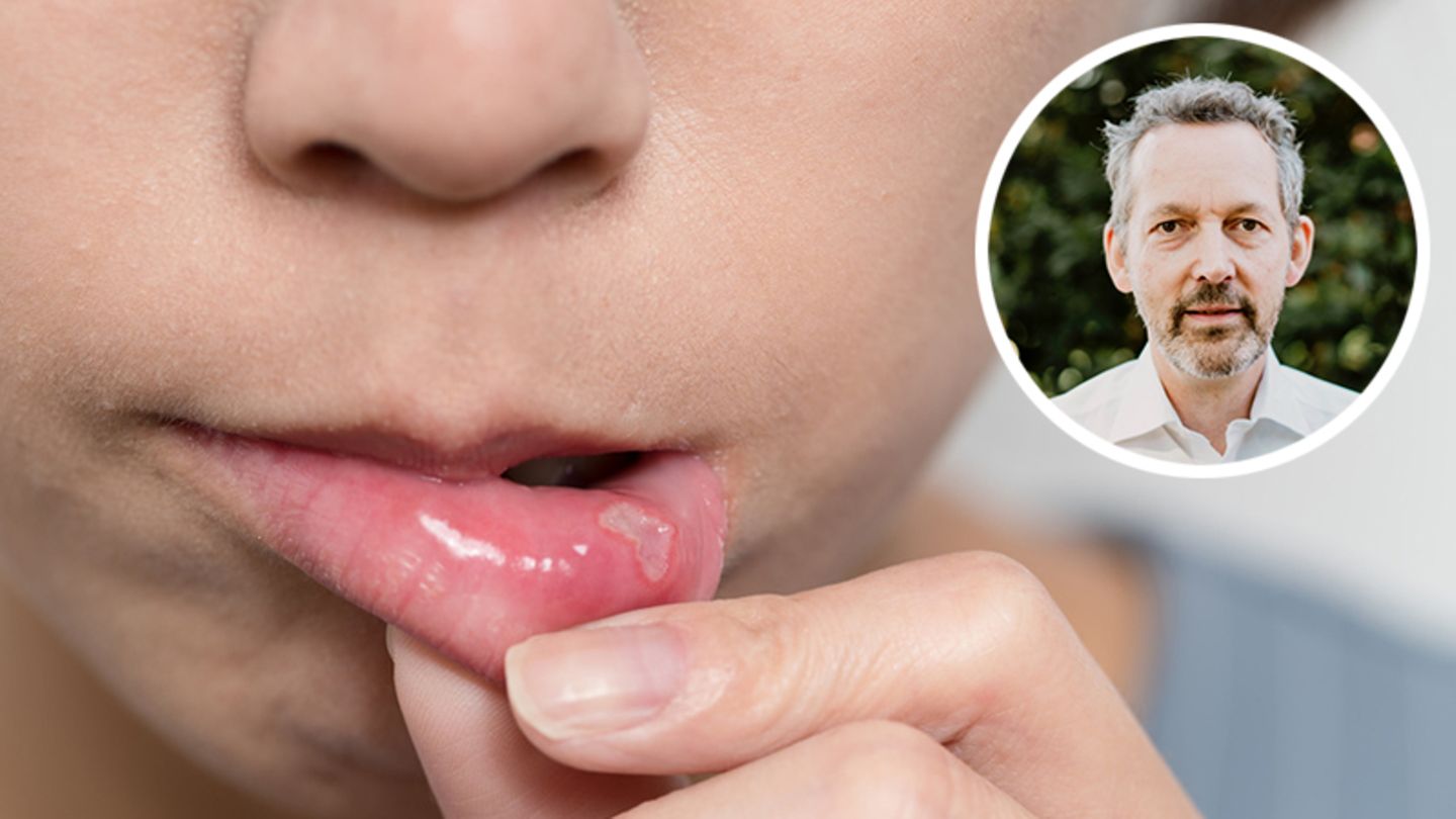 Dermatologie: Nervige Stellen im Mund: Wie werde ich Aphthen und co. los?