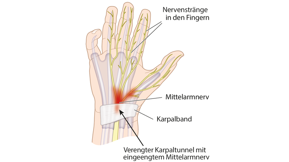 Darstellung einer Hand mit Karpaltunnelsyndrom