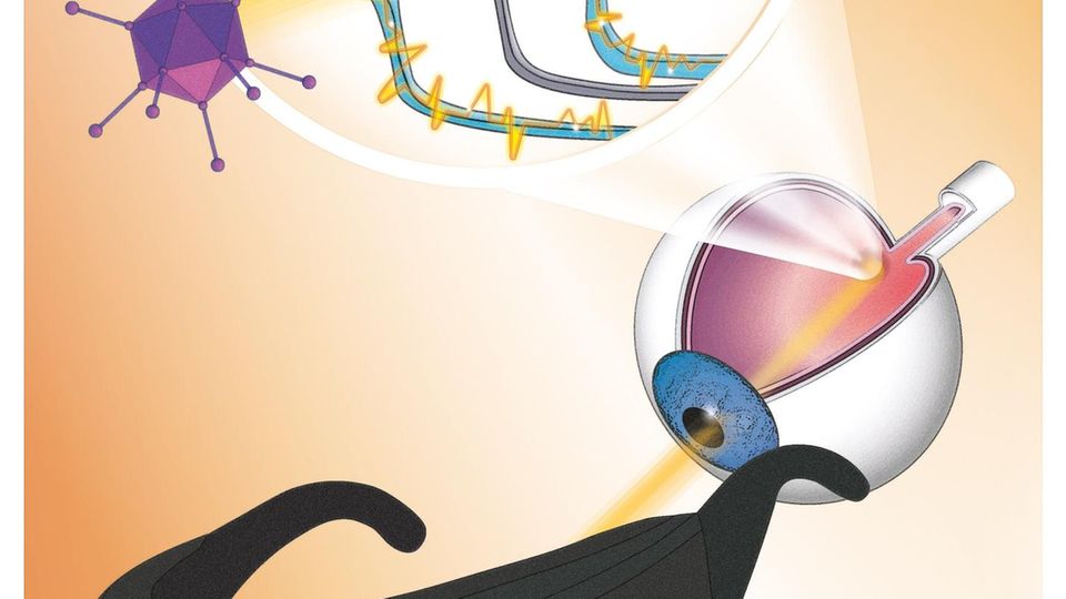 Optogenetik: Durch die neue Gentherapie wird die Netzhaut eines Blinden lichtempfindlich gemacht und durch eine lichtstimulierende Schutzbrille beleuchtet, die mit einer neuromorphen Kamera Bilder aus der visuellen Welt aufnimmt Durch die neue Gentherapie wird die Netzhaut eines Blinden lichtempfindlich gemacht und durch eine lichtstimulierende Schutzbrille beleuchtet, die mit einer neuromorphen Kamera Bilder aus der visuellen Welt aufnimmt