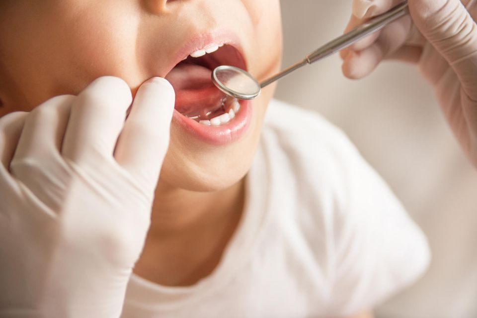 Laut Zahnreport der Barmer-Krankenkasse hätten mindestens 450 000 Kinder in Deutschland Kreidezähne