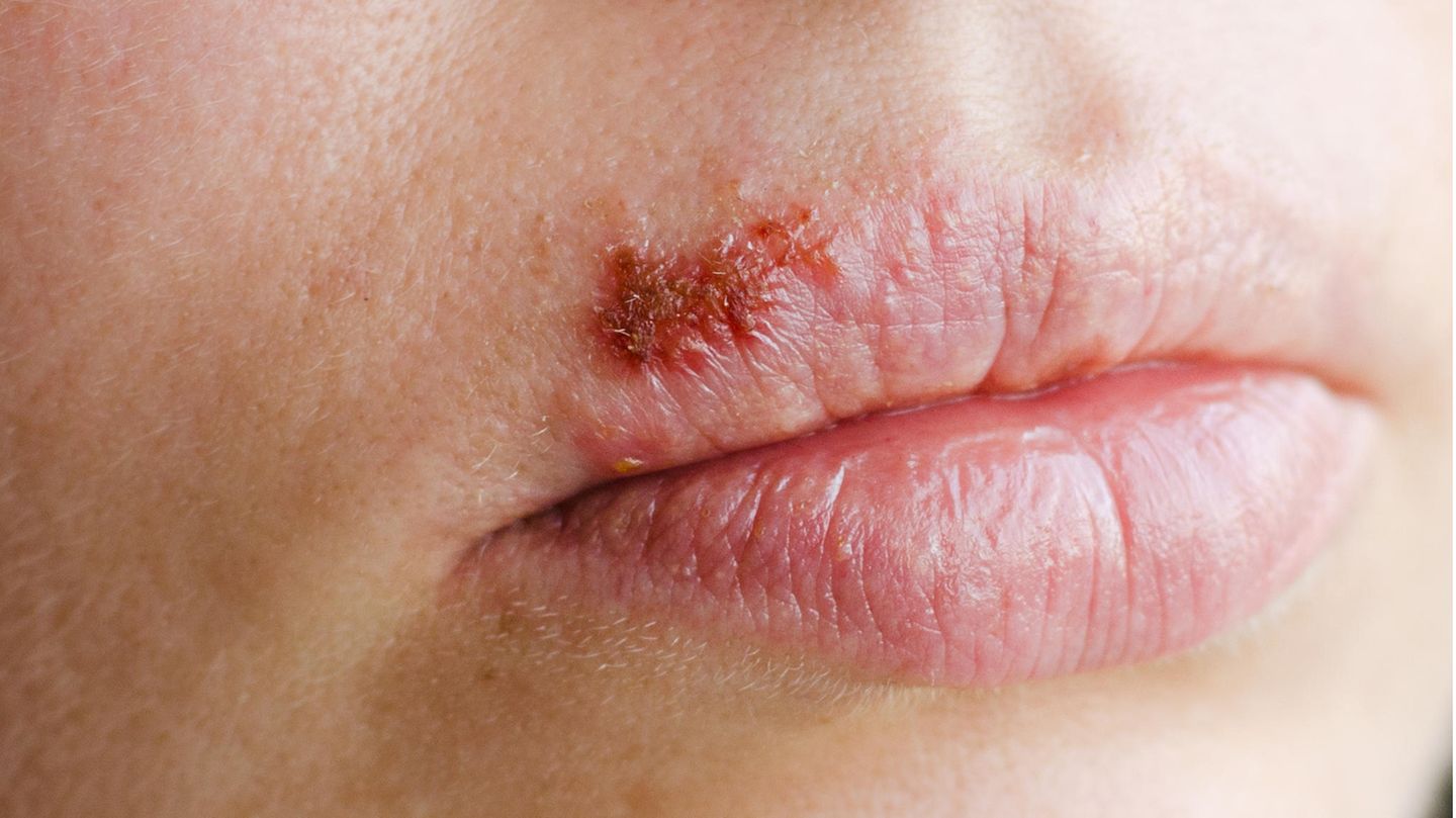 Lippenherpes