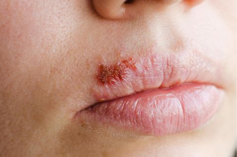 Lippenherpes
