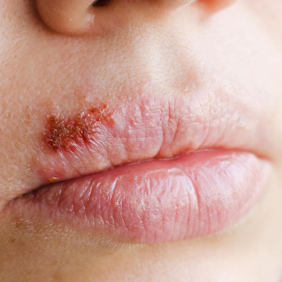 Lippenherpes