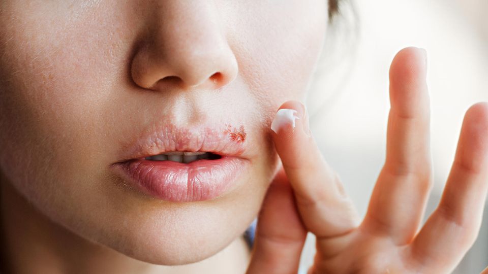 Frau mit Lippenherpes