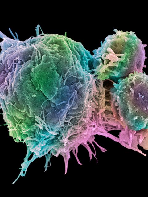 Kampf gegen Tumore: Was mit modernen Krebstherapien alles möglich ist