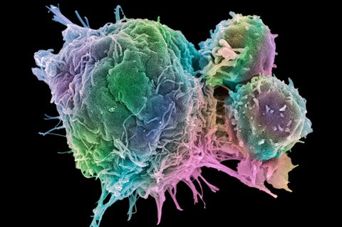 Kampf gegen Tumore: Was mit modernen Krebstherapien alles möglich ist