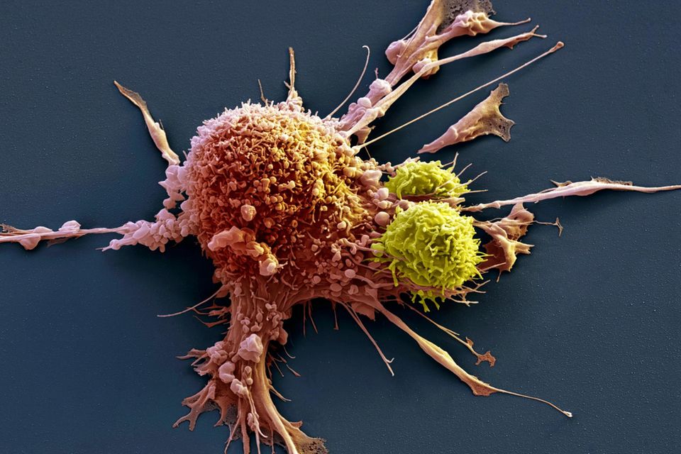 T-Zellen attackieren eine Krebszelle