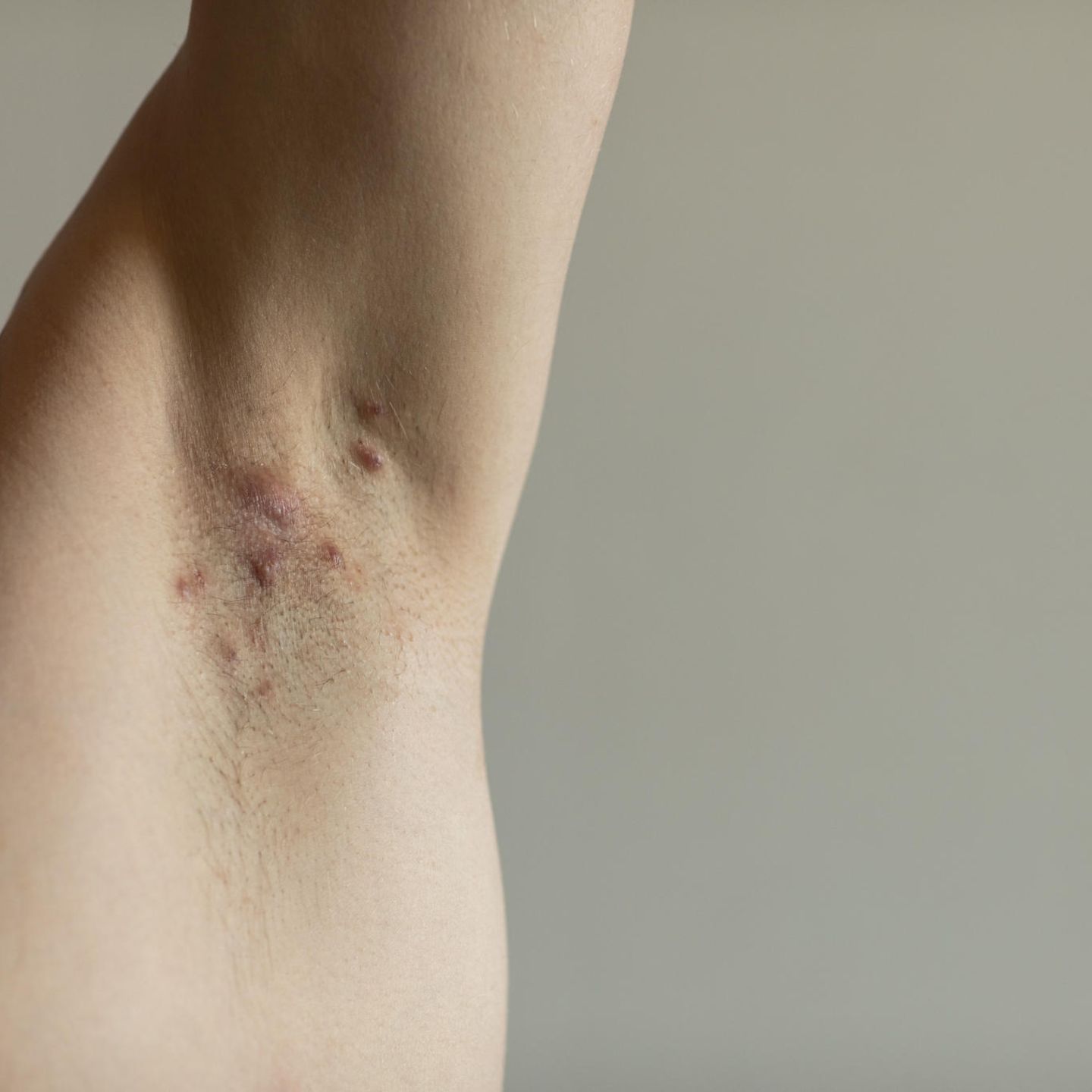 e-zigarette akne inversa Akne inversa: Therapieansätze geben Hoffnung