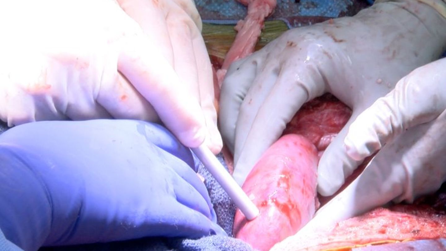 Xenotransplantation