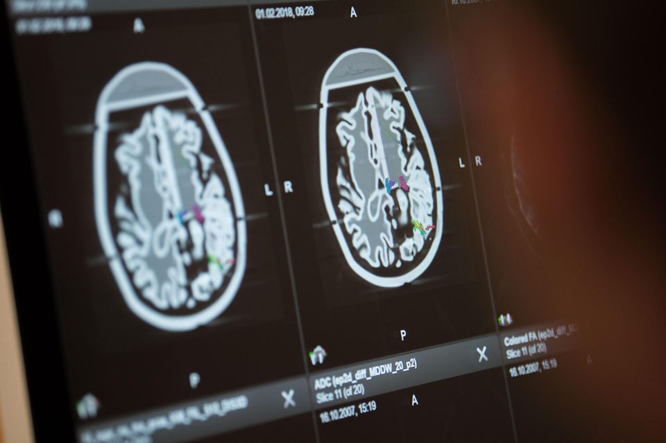Auf einem Monitor werden Querschnitte von einem menschlichen Hirn angezeigt.