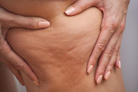 Cellulite am Oberschenkel