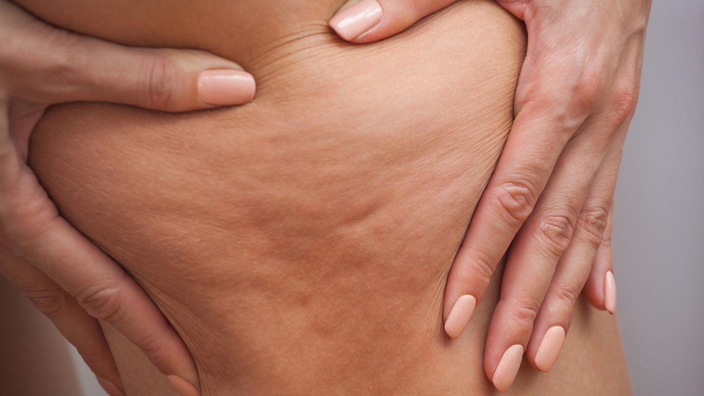 Cellulite am Oberschenkel