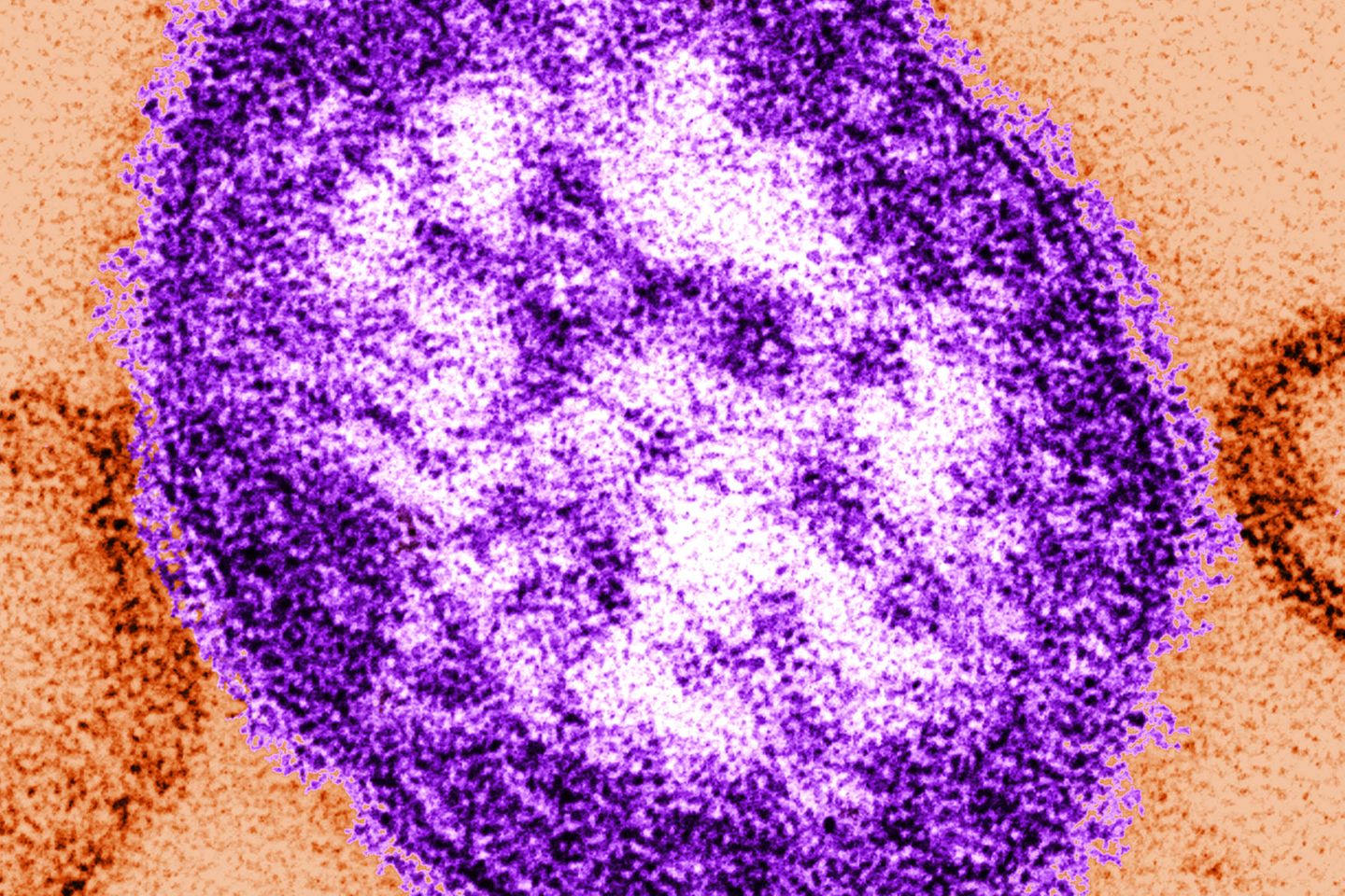Masernvirus unter dem Transmissionselektronenmikroskop: Die Masern-Fälle weltweit steigen sehr rasch. Die Weltgesundheitsorganisation (WHO) sieht deshalb Millionen Kinder in Gefahr