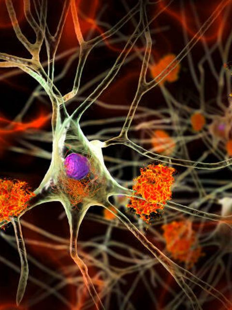 Viele Leiden beginnen in den kleinsten Einheiten des Körpers: den Zellen. An dieser von Alzheimer befallenen Nervenzelle im Gehirn etwa lagern sich verklumpte Proteine (orange) ab. Um solche Krankheiten früher zu erkennen, untersuchen Forschende deshalb gezielt die genetische Aktivität ein­zelner Zellen aus Geweben