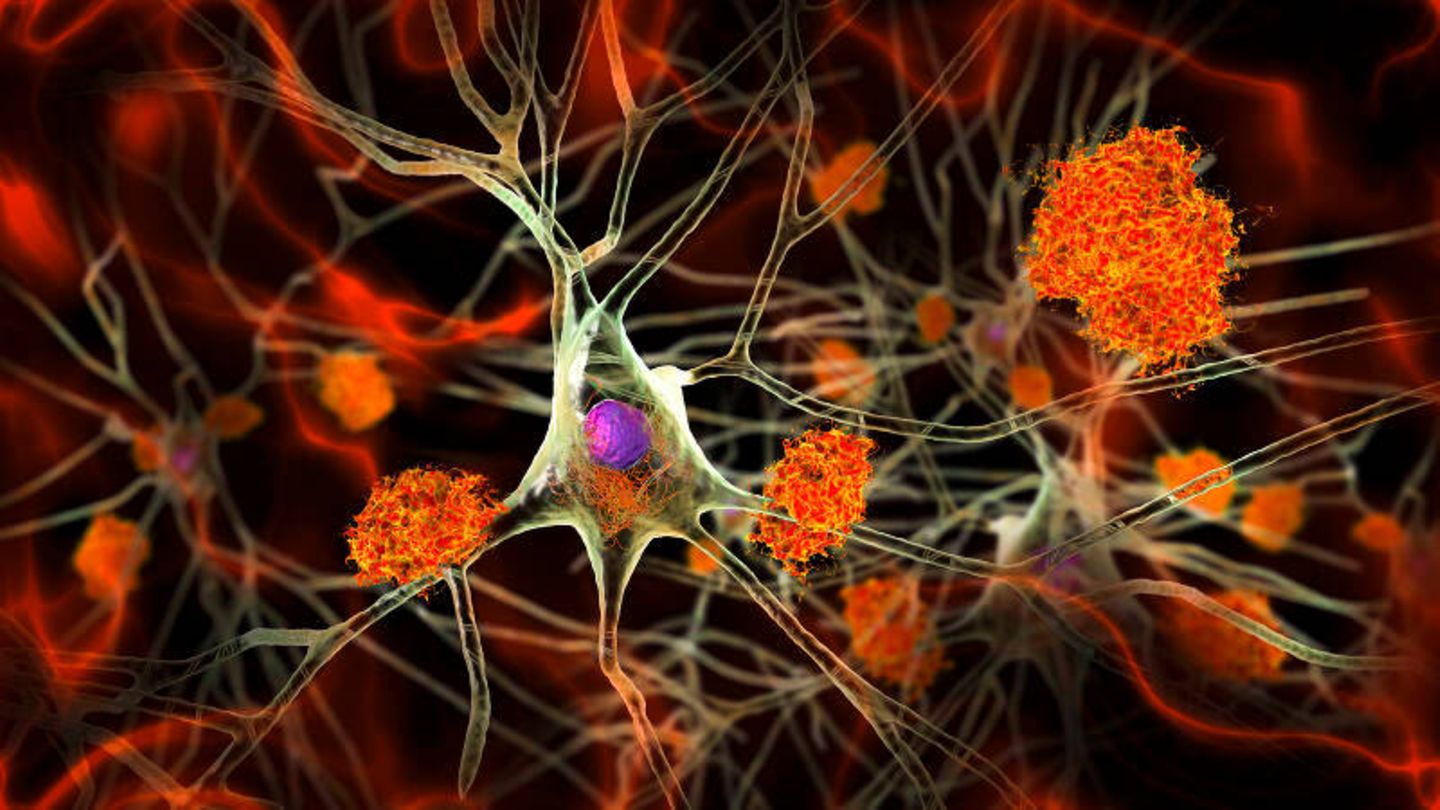 Viele Leiden beginnen in den kleinsten Einheiten des Körpers: den Zellen. An dieser von Alzheimer befallenen Nervenzelle im Gehirn etwa lagern sich verklumpte Proteine (orange) ab. Um solche Krankheiten früher zu erkennen, untersuchen Forschende deshalb gezielt die genetische Aktivität ein­zelner Zellen aus Geweben