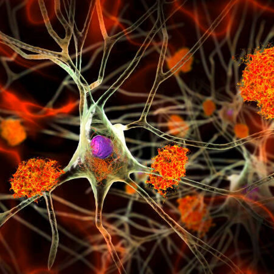 Viele Leiden beginnen in den kleinsten Einheiten des Körpers: den Zellen. An dieser von Alzheimer befallenen Nervenzelle im Gehirn etwa lagern sich verklumpte Proteine (orange) ab. Um solche Krankheiten früher zu erkennen, untersuchen Forschende deshalb gezielt die genetische Aktivität ein­zelner Zellen aus Geweben