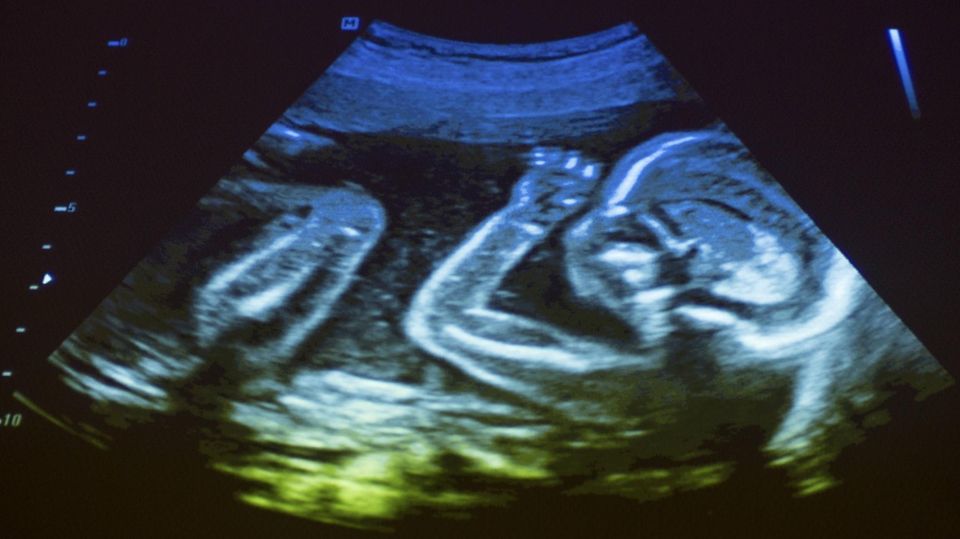 Ultraschall-Aufnahme eines Fötus im Mutterleib Ultraschall-Aufnahme eines Fötus im Mutterleib