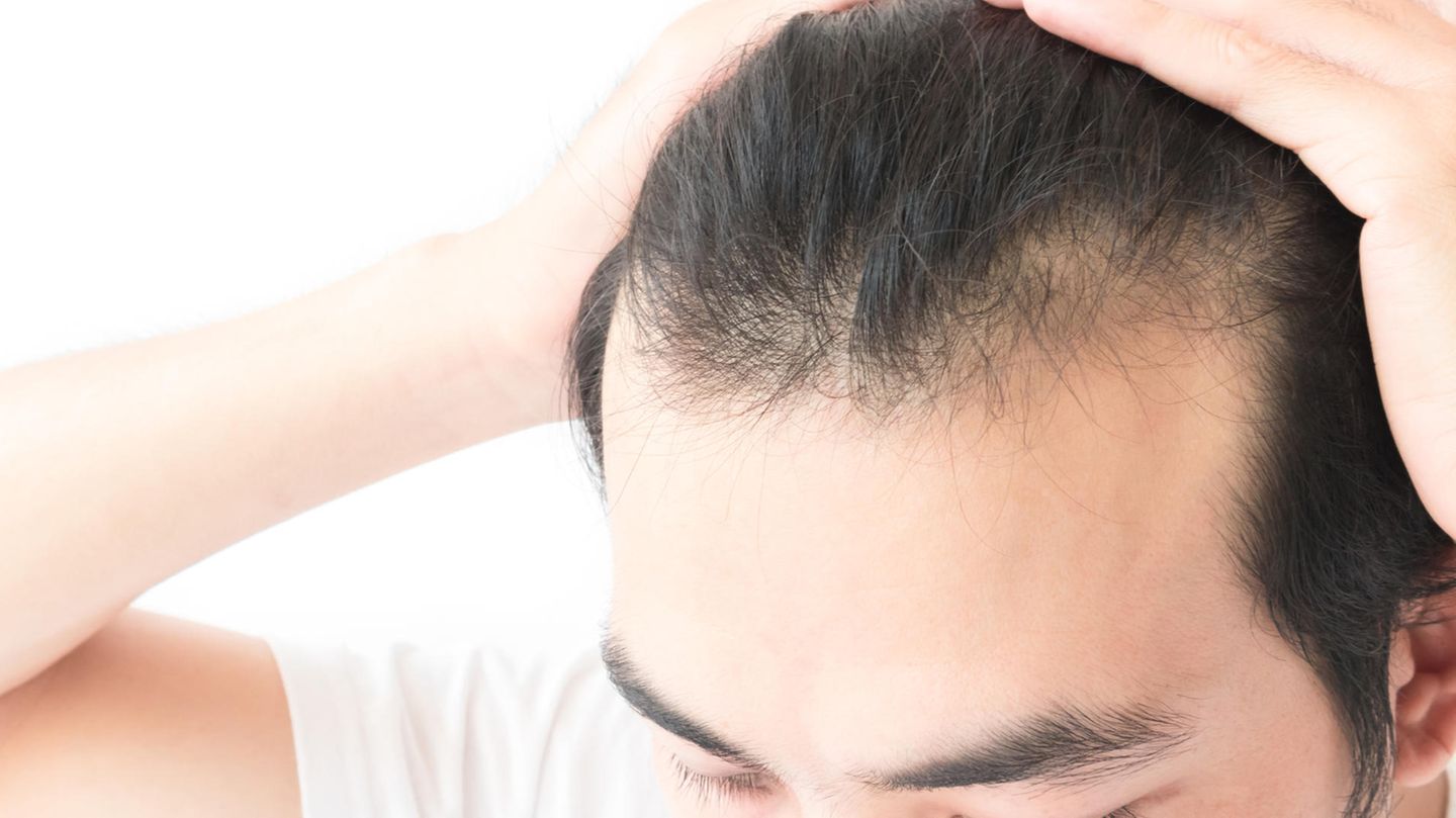 Mann mit Haarausfall Mann mit Haarausfall