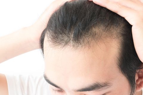 Mann mit Haarausfall