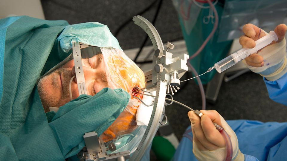Obwohl er bei Bewusstsein ist, wenn sein Gehirn eröffnet wird, spürt Broschart von dem Eingriff kaum etwas. Dafür sorgen Beruhigungsmittel und der Umstand, dass das Hirn keinen eigenen Schmerz fühlt 