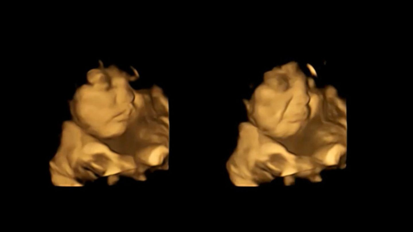 4D-Scan-Bild von einem Fötus