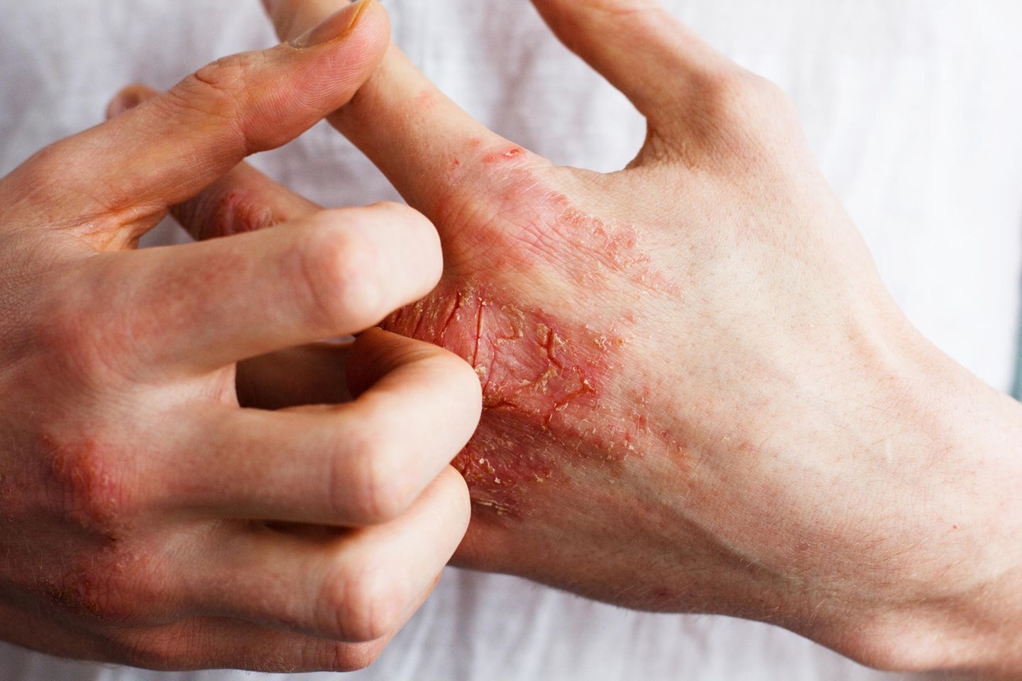Schuppenflechte (Psoriasis vulgaris) ist eine entzündliche Erkrankung der Haut, die meist vererbt wird