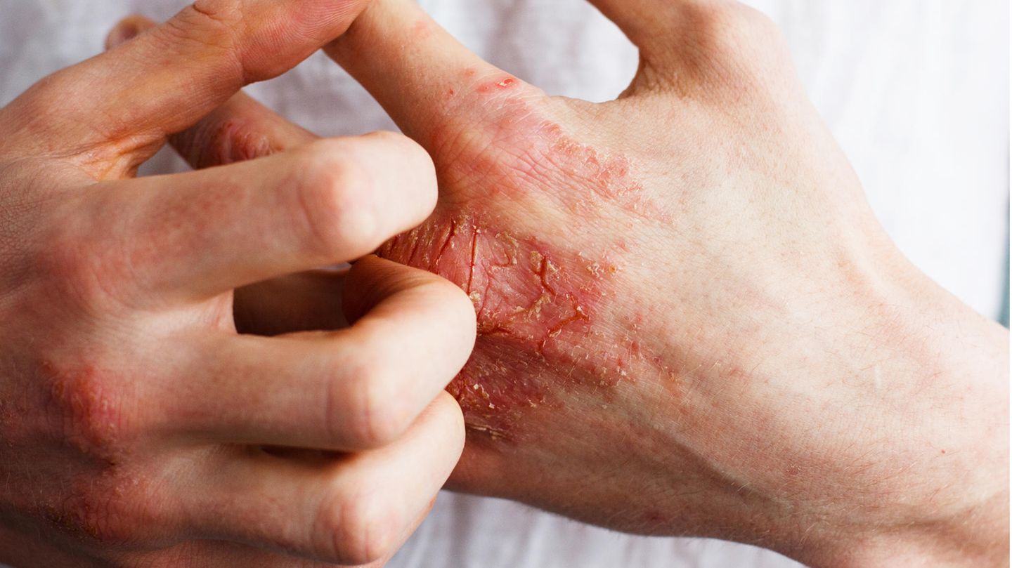 Schuppenflechte (Psoriasis vulgaris) ist eine entzündliche Erkrankung der Haut, die meist vererbt wird