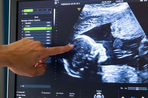 Während einer pränatalen Ultraschall-Untersuchung einer in der 18. Woche schwangeren Frau deutet ein Arzt auf den Kopf des Kinde