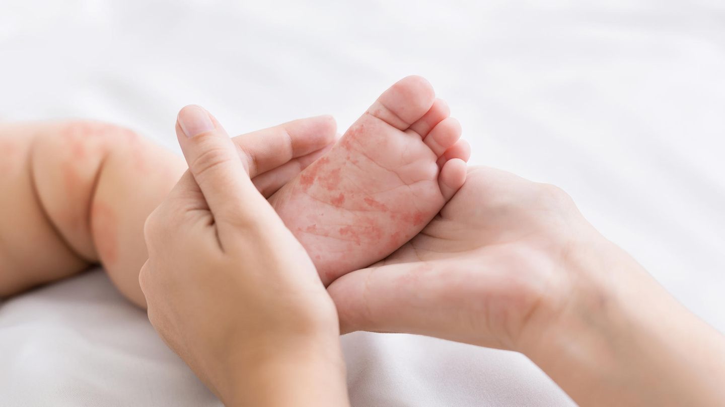 Mutter hält einen Babyfuß mit Hautausschlag