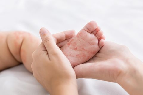 Mutter hält einen Babyfuß mit Hautausschlag