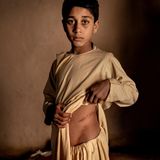 Ein Junge schaut in die Kamera und hält sein Oberteil hoch, wodurch eine große Narbe an der Taille zu sehen ist