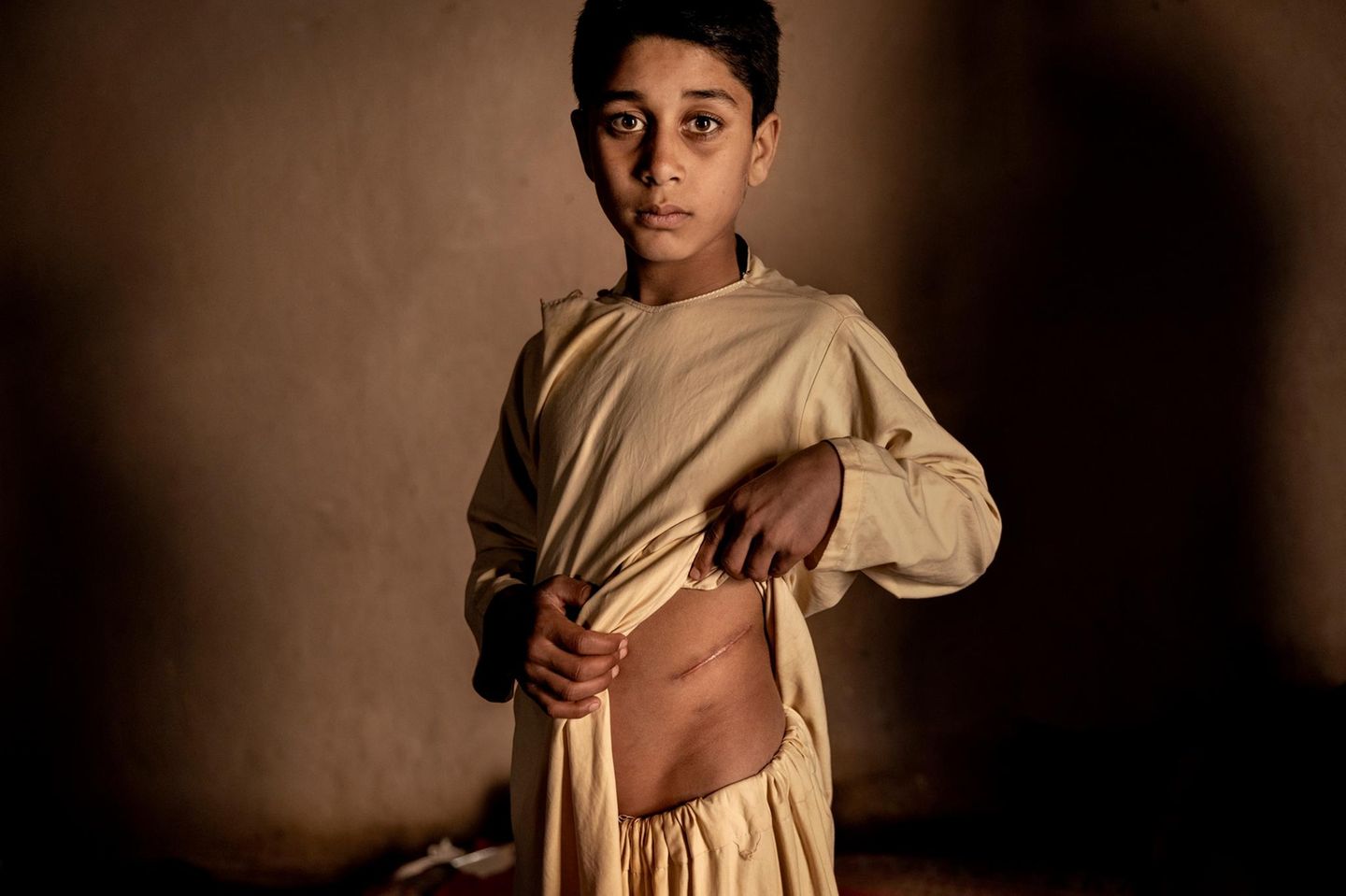 Geschichte des Jahres: "The Price of Peace in Afghanistan" von Mads Nissen Ein Junge schaut in die Kamera und hält sein Oberteil hoch, wodurch eine große Narbe an der Taille zu sehen ist
