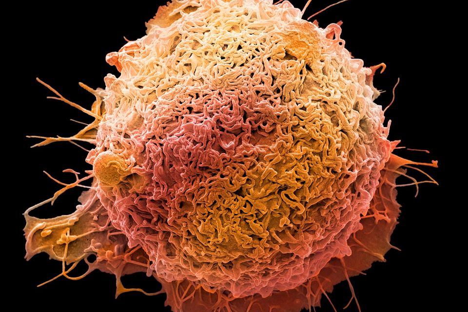 Eine orange eingefärbte Darmkrebszelle als Elektronen Raster Mikroskopaufnahme vor schwarzem Hintergrund.