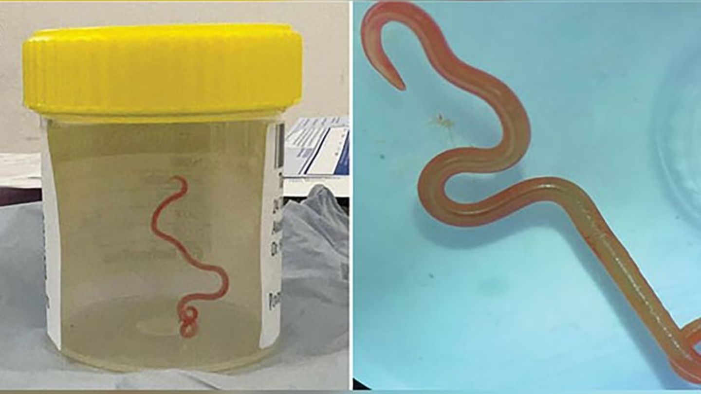 Das undatiertes Bild zeigt den lebenden Spulwurm "Ophidascaris robertsi", der das Gehirn einer 64-jährigen Australierin befallen hatte - und Neurochirurgen verblüffte