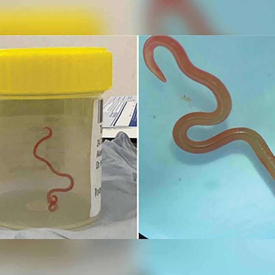 Das undatiertes Bild zeigt den lebenden Spulwurm "Ophidascaris robertsi", der das Gehirn einer 64-jährigen Australierin befallen hatte - und Neurochirurgen verblüffte