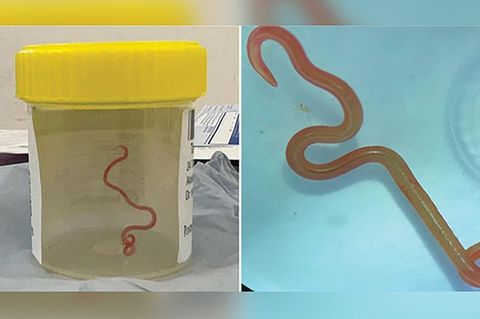Das undatiertes Bild zeigt den lebenden Spulwurm "Ophidascaris robertsi", der das Gehirn einer 64-jährigen Australierin befallen hatte - und Neurochirurgen verblüffte