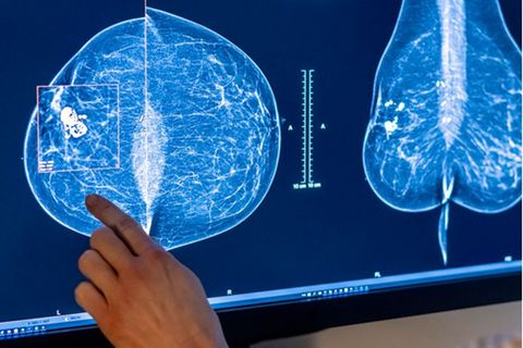Mammografie in einer Klinik in Berlin. Frauen sind nicht nur von Brustkrebs betroffen, sondern häufig auch von Gebärmutter-, Lun