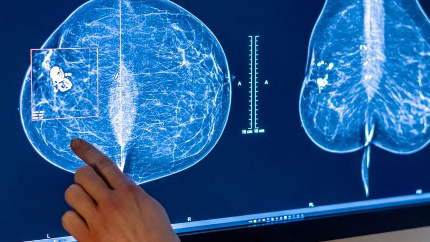 Mammografie in einer Klinik in Berlin. Frauen sind nicht nur von Brustkrebs betroffen, sondern häufig auch von Gebärmutter-, Lun