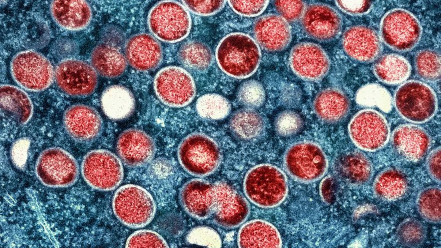 Viruela simica: los virus Mpox circularon desapercibidos durante años