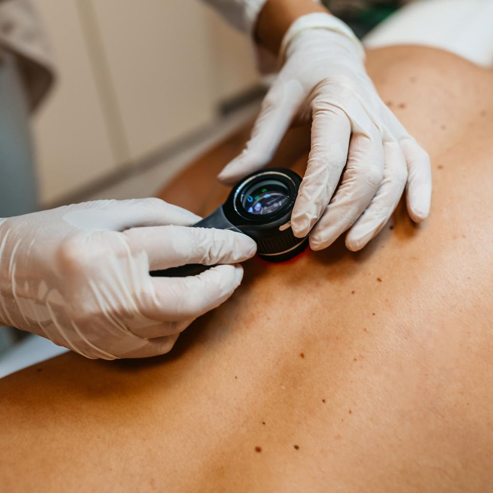 Muttermalkontrolle bei einem Mann