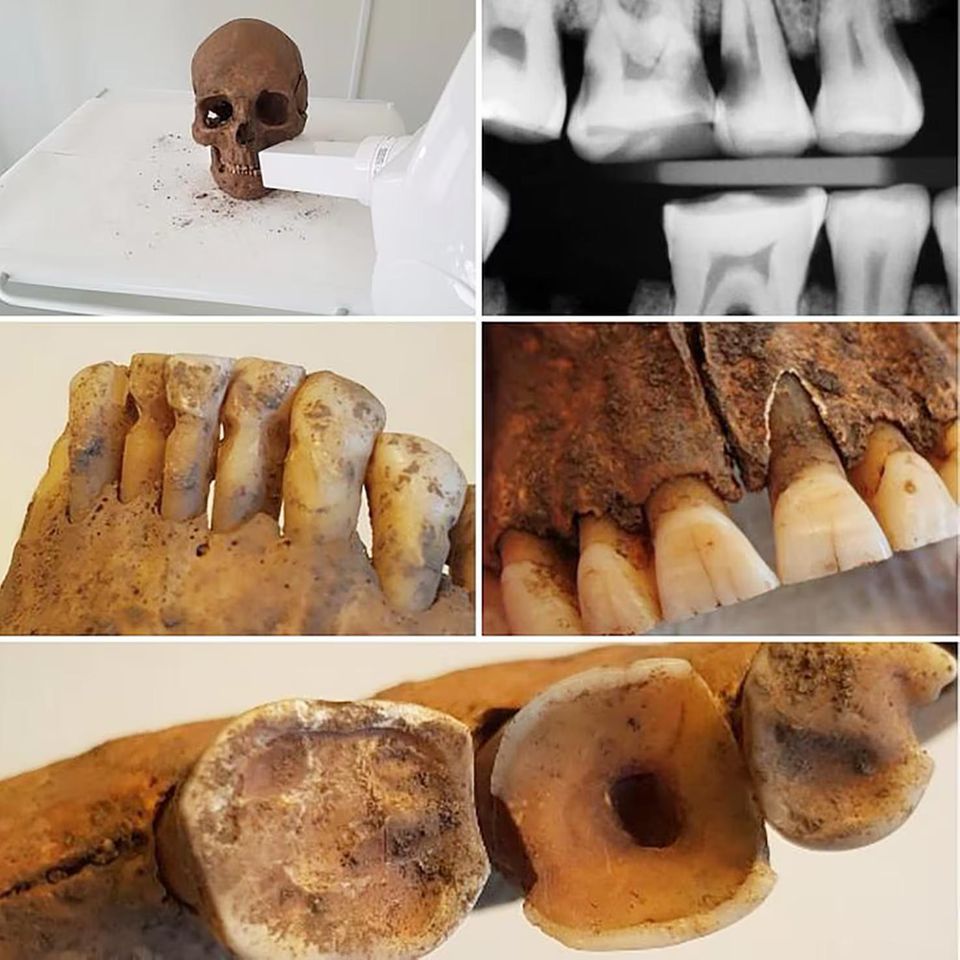 Schädel, Röntgenbild und Fotos von Zähnen der Wikingerzeit Schädel, Röntgenbild und Fotos von Zähnen der Wikingerzeit