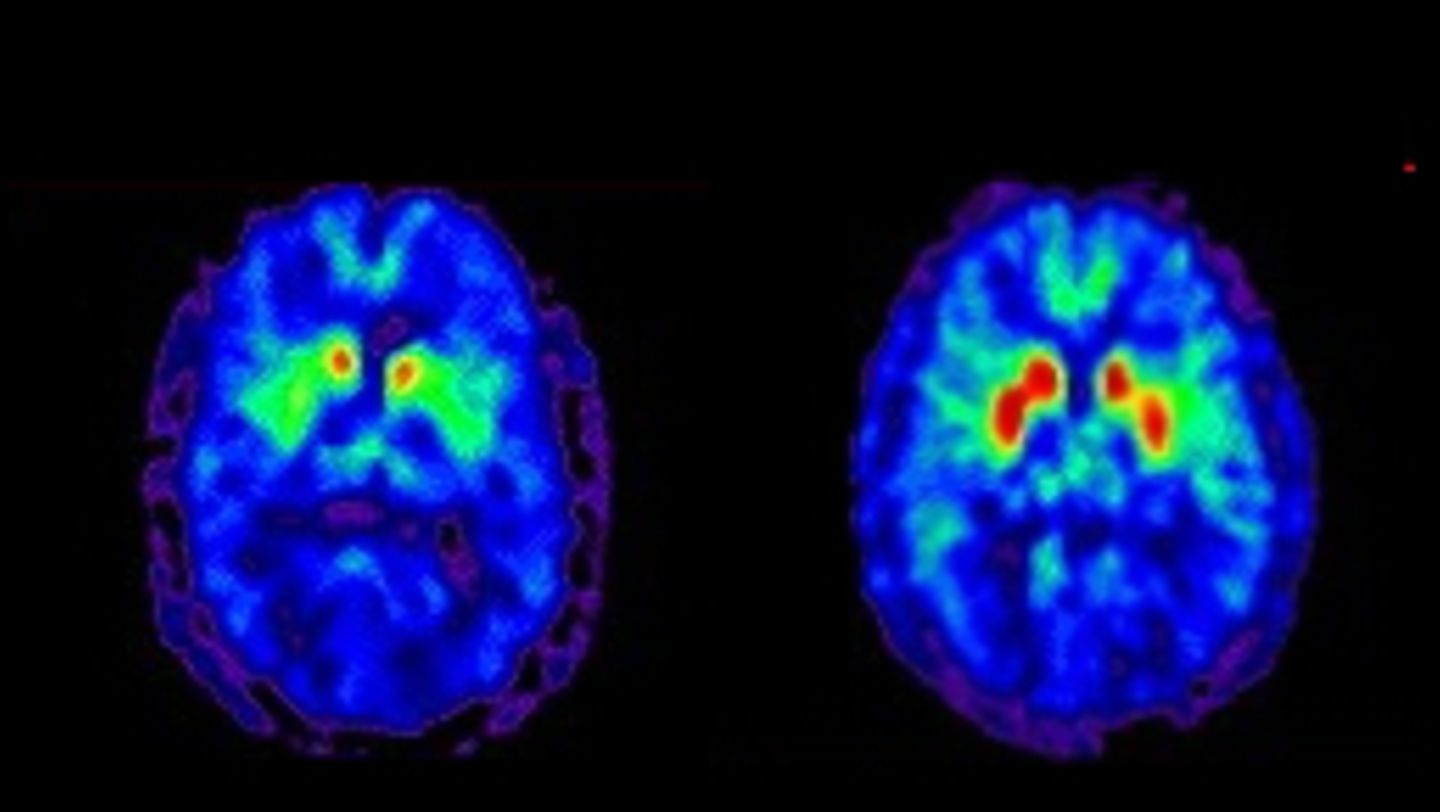 Zwei PET-Scans des menschlichen Gehirns im Vergleich, beide leuchten (von innen nach aussen) rot, gelb, grün, blau, lila