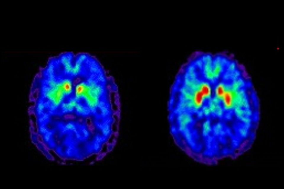 Zwei PET-Scans des menschlichen Gehirns im Vergleich, beide leuchten (von innen nach aussen) rot, gelb, grün, blau, lila